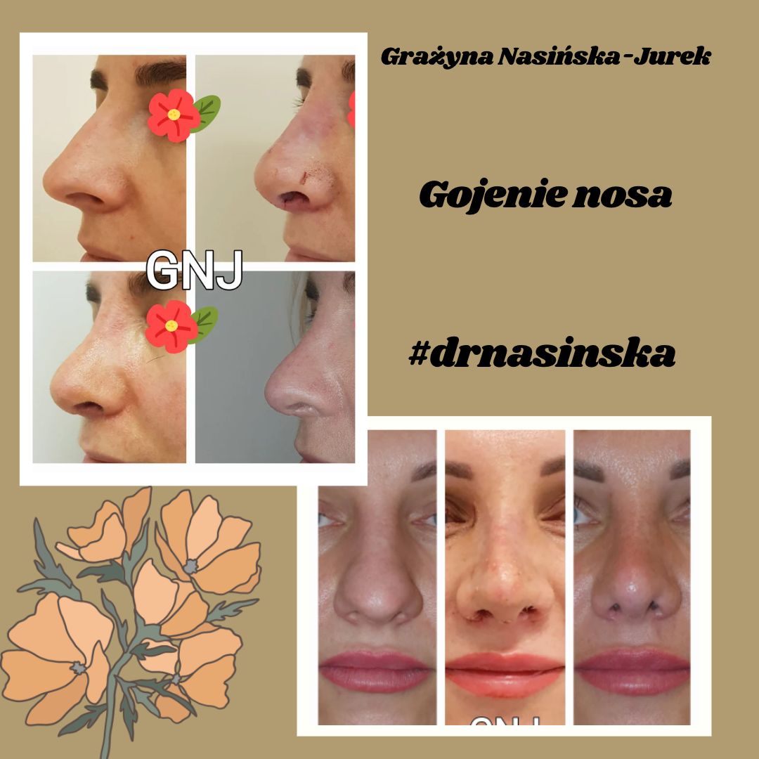 Gojenie po operacji nosa